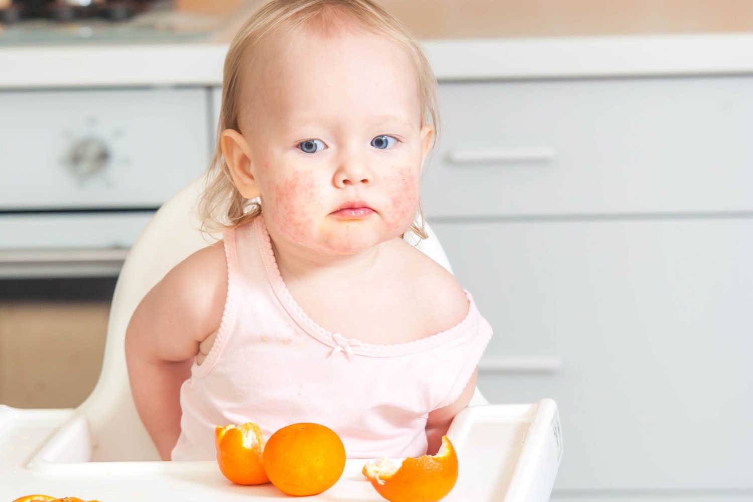 Food Allergies In Babies Signs Preventive Measures And Treatment