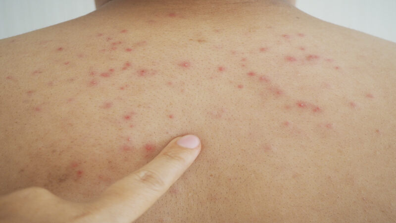 Home Remedies For Prickly Heat Rashes In Children