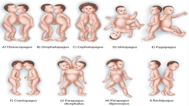 Classification Of Conjoined Twins