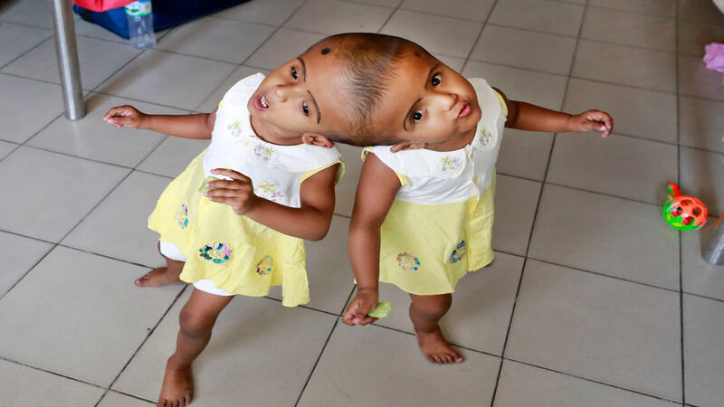 Diagnosis Of Conjoined Twins