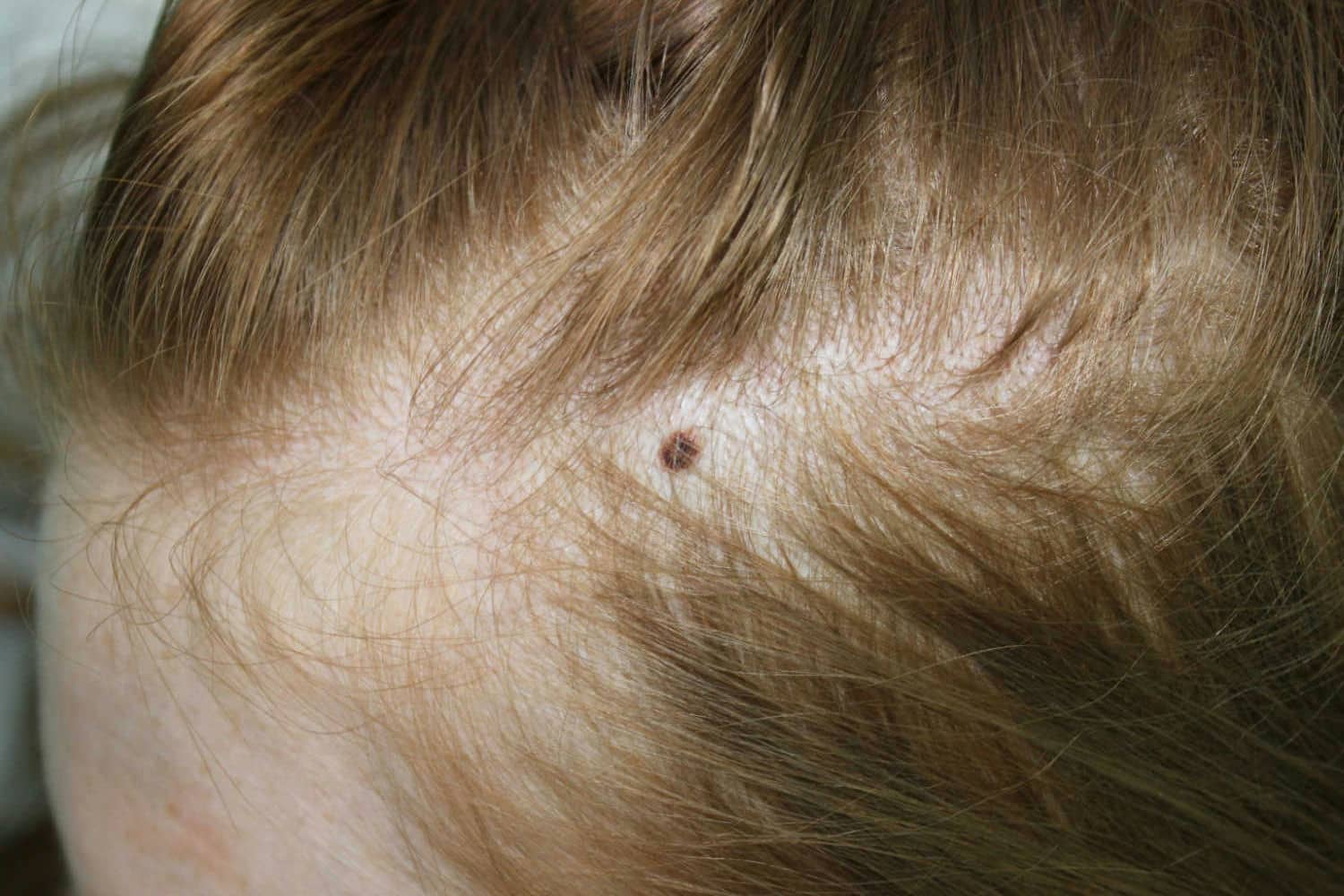 What Are Birthmarks? What Are Their Different Types? - Being The Parent