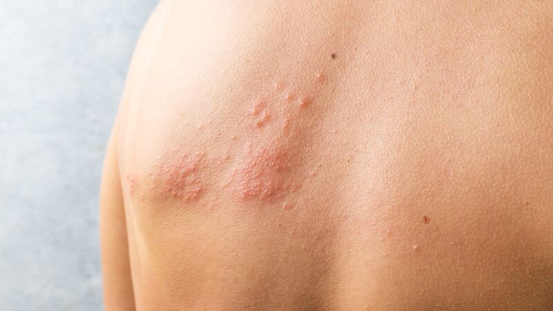 Shingles In Toddlers – Causes, Symptoms, And Treatment