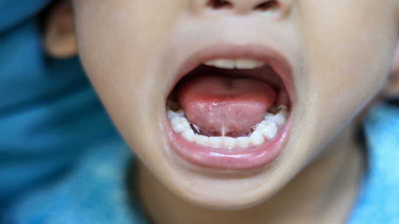 Tongue-Tie In Toddlers – Causes, Symptoms & Treatments