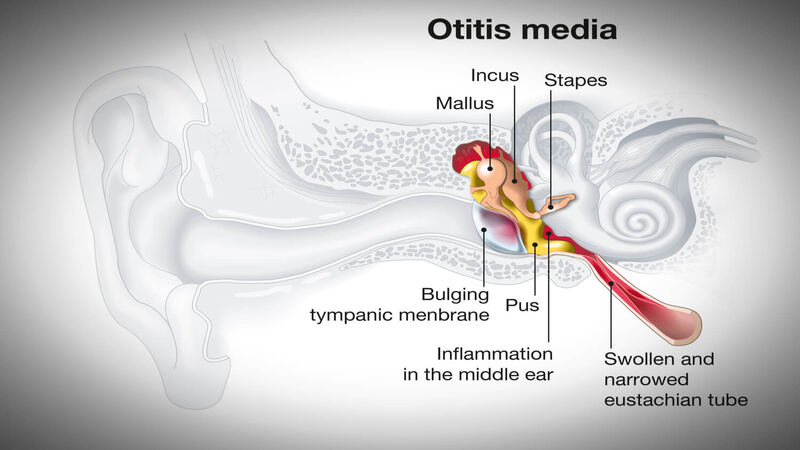 Acute-Otitis-Media