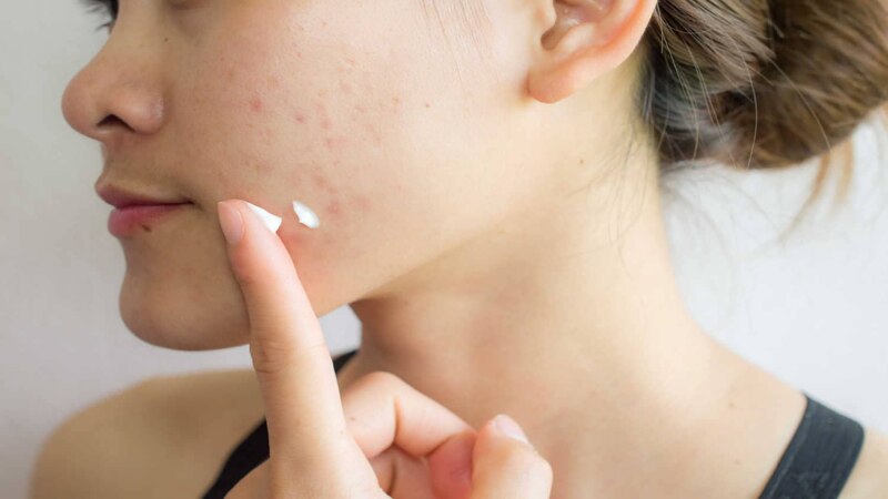 Are-Acne-Medications-Safe-To-