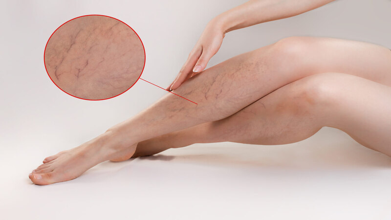 Varicose-veins-in-women