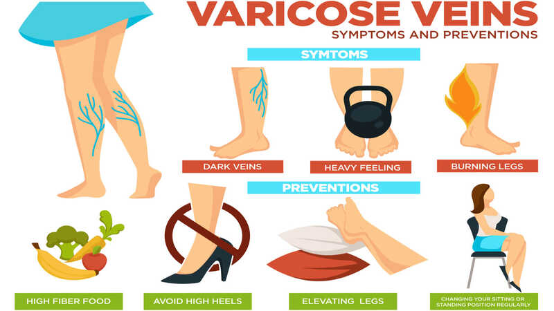 Varicose-veins-symptoms