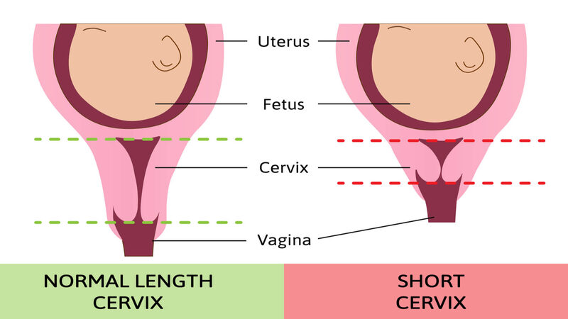 Cervical Length in pregnancy