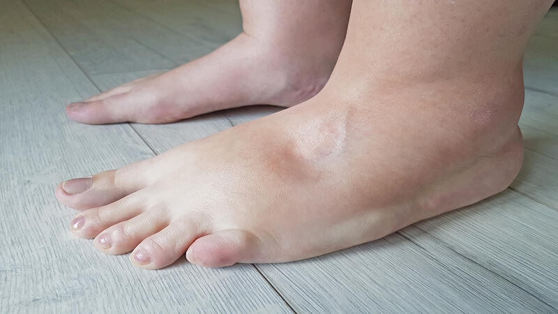 12 Simple And Effective Ways To Cure Postpartum Edema