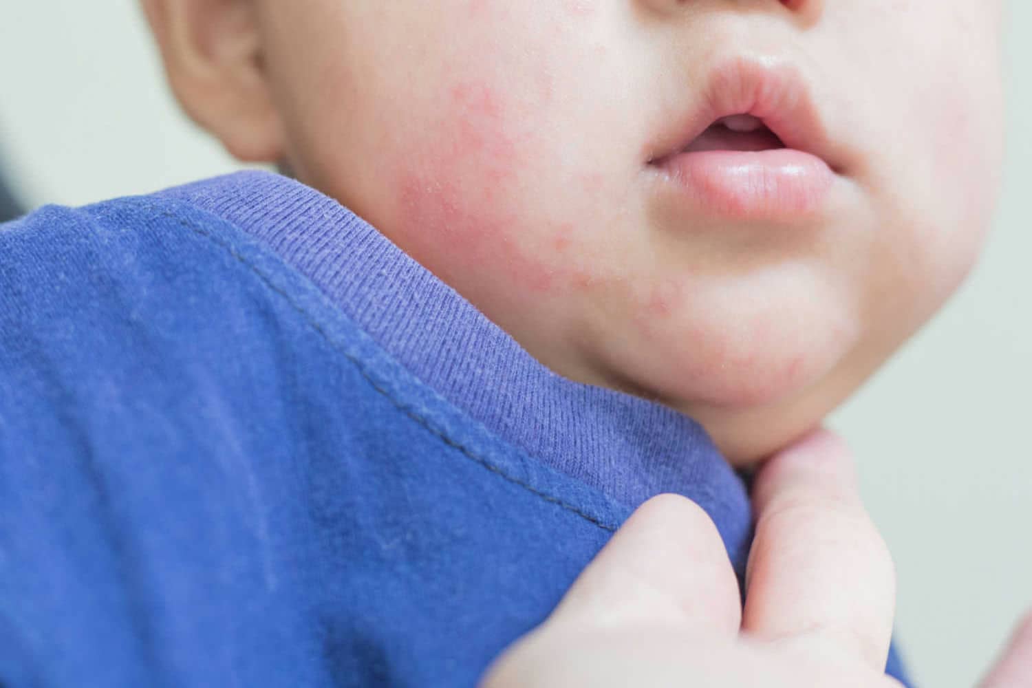 Fungal Skin Infections In Babies Causes Symptoms And Treatment 