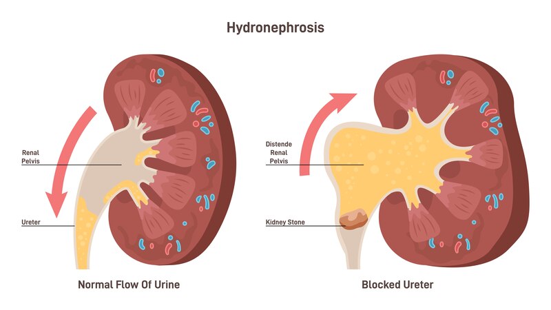 Hydronephrosis