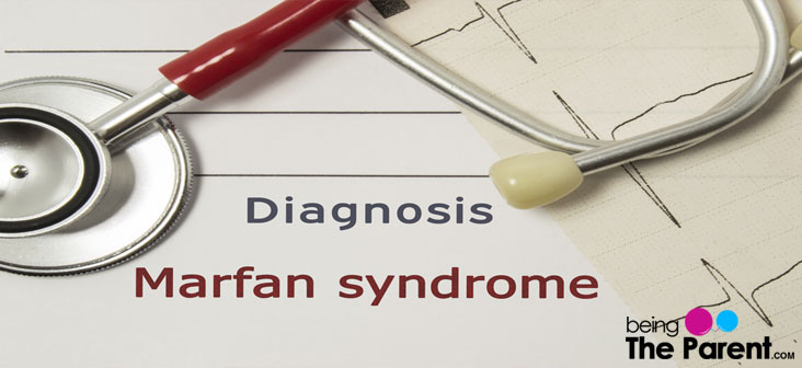 Marfan Syndrome In Pregnancy - Causes, Symptoms & Treatment - Being The ...