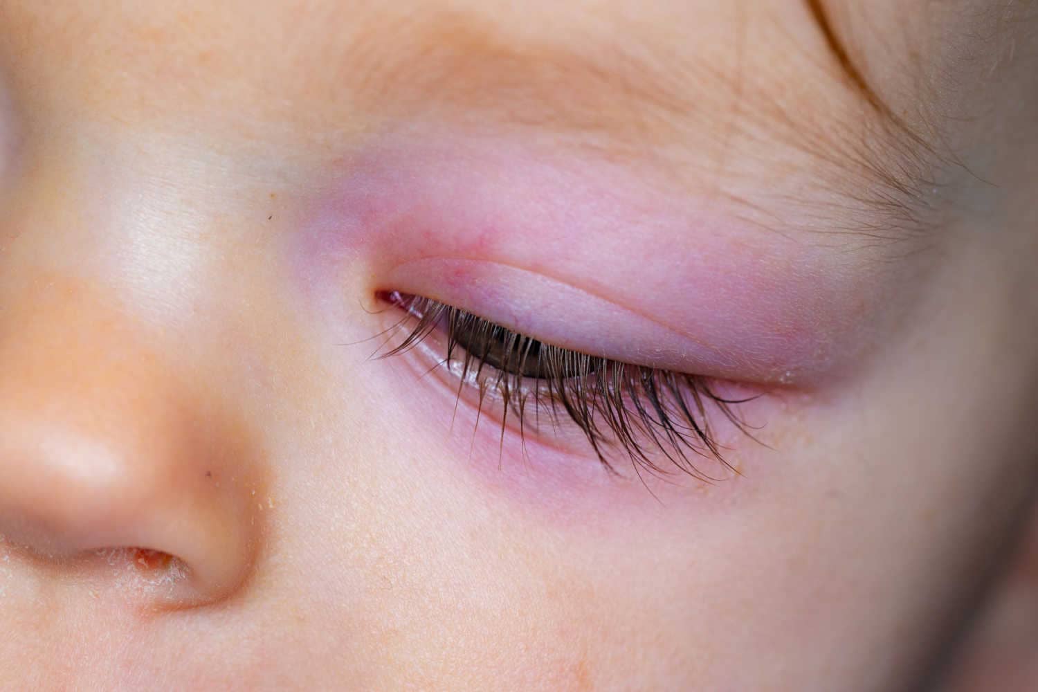 Pink Eye In Babies Causes, Symptoms And Treatment Being The Parent