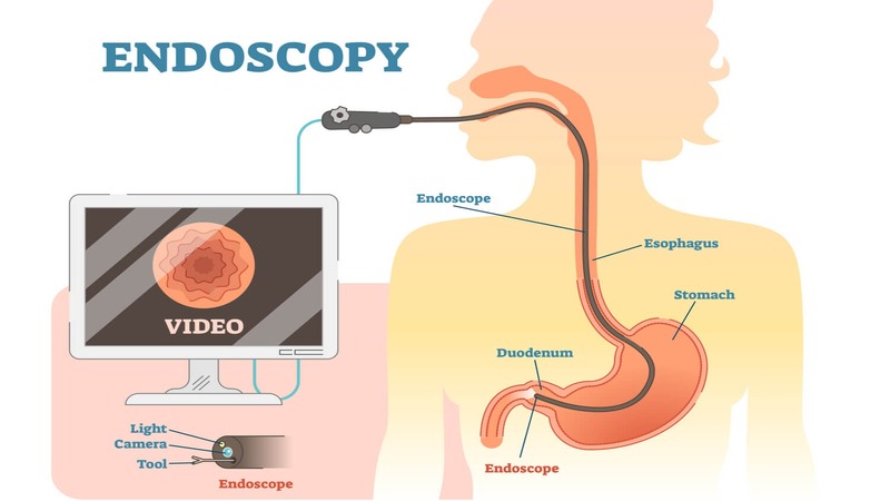 Endoscopy