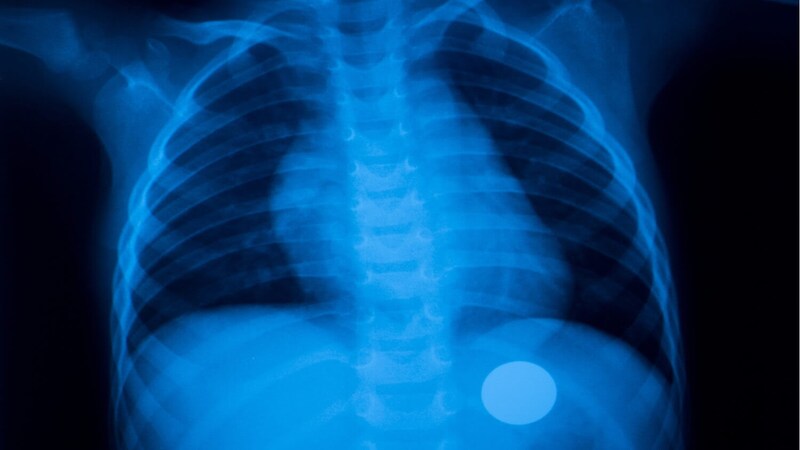 Xray-of-child-swallowed-coin