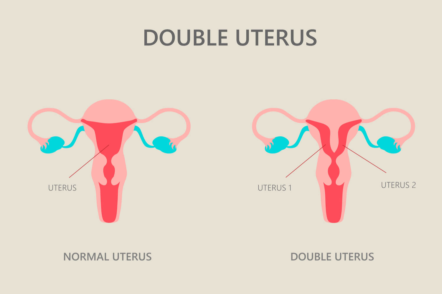 Uterus Didelphys Causes Symptoms And Complications Being The Parent
