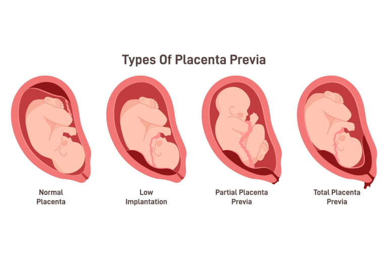 Placenta Previa: Symptoms, Causes And Treatment - Being The Parent