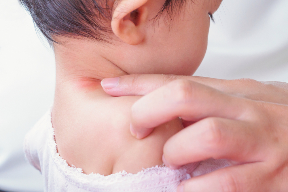 Baby Neck Rash Causes, Symptoms & Remedies Being The