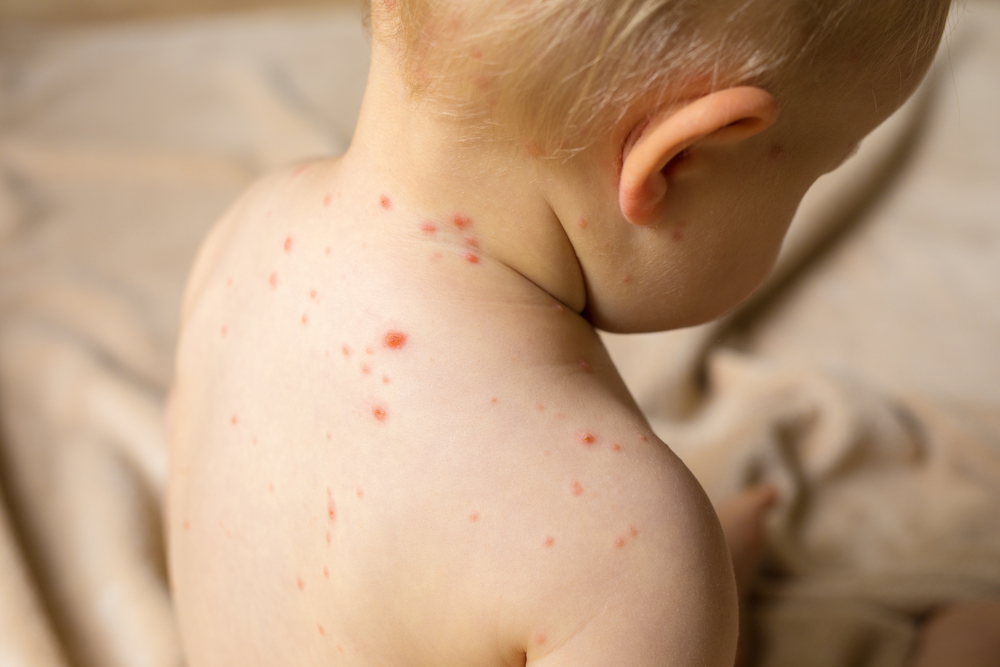 Measles in Babies