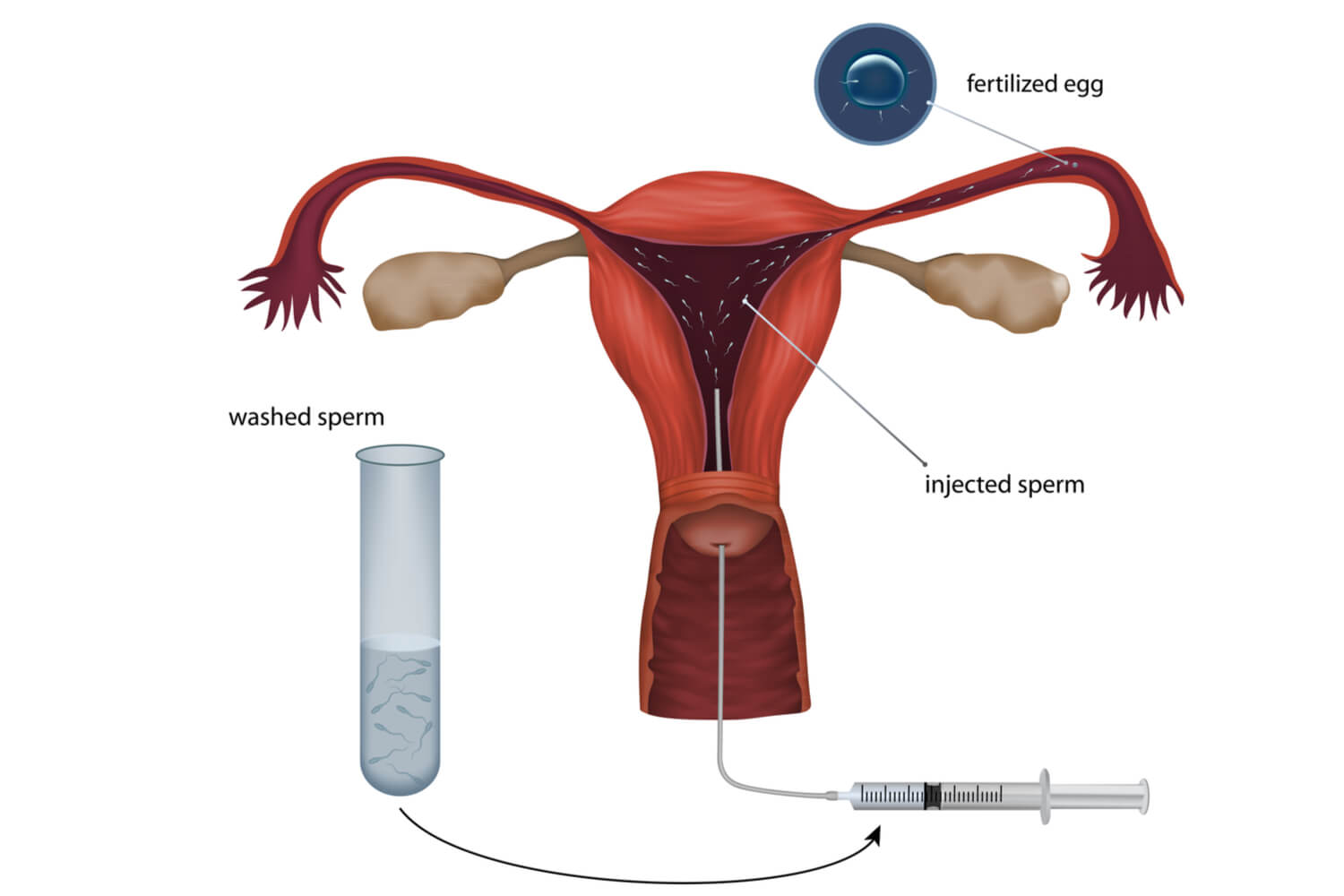 Artificial Insemination Process Pros And Cons Being The Parent