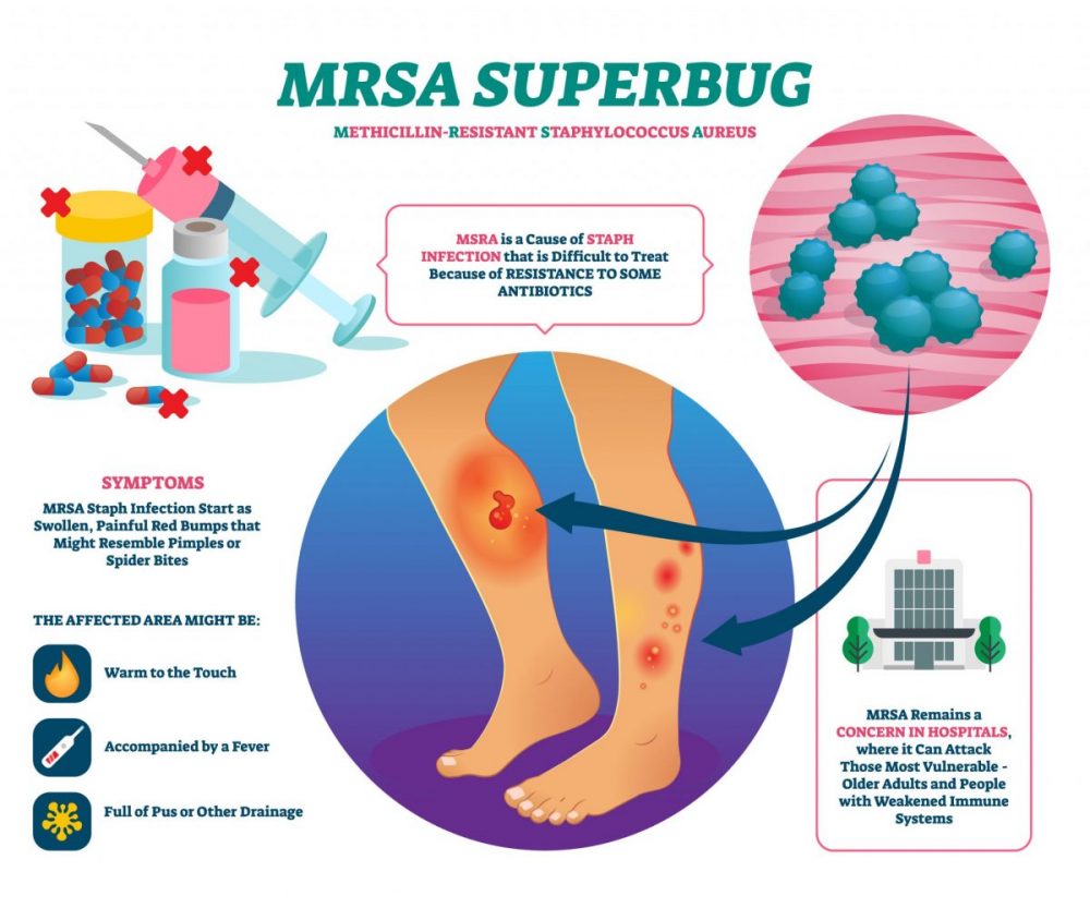 mrsa-in-children-causes-and-treatment-by-dr-srikanta-j-t-being-the