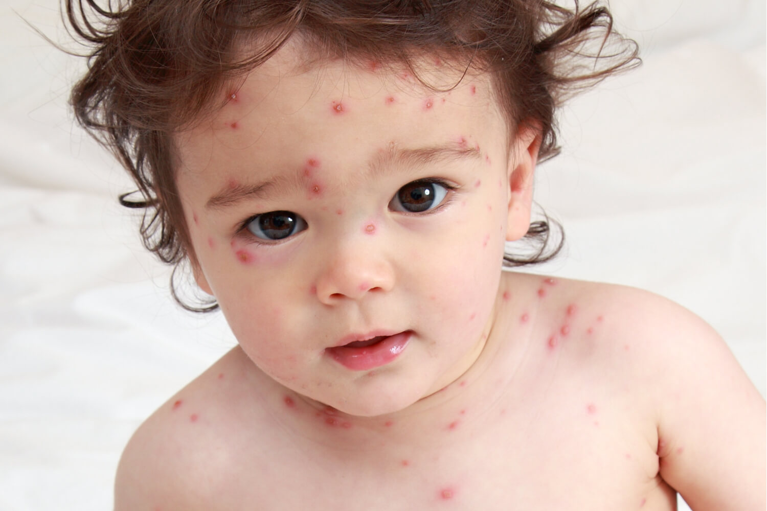 Viral Rashes in Babies – Types, Symptoms and Treatment - Being The Parent