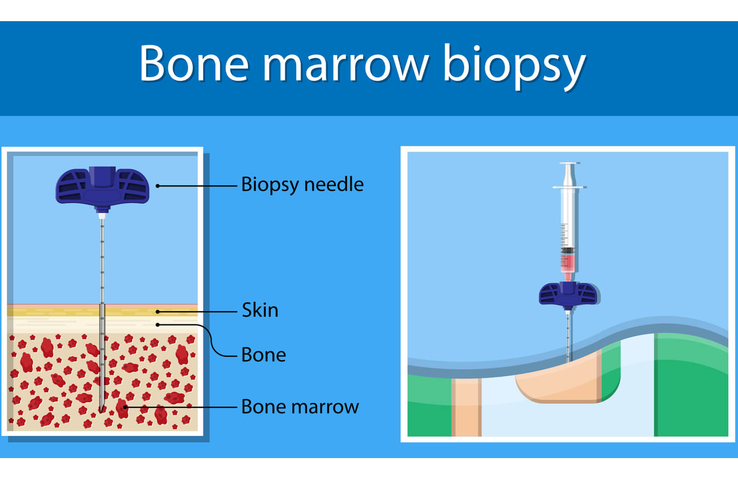 Blood Cancer in Children - Symptoms, Diagnosis, and Treatment