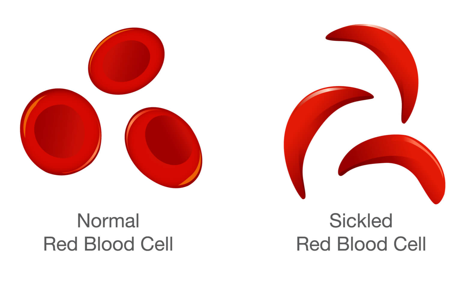 Sickle Cell Disease in Children: Symptoms, Diagnosis and Prevention by ...