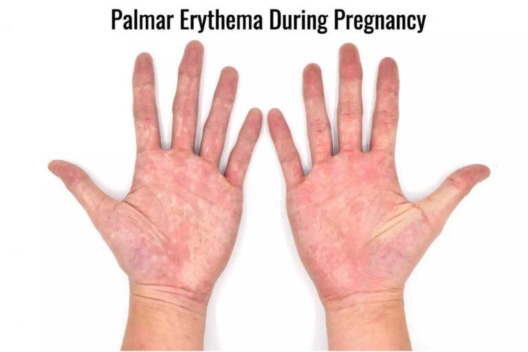 Red Blotches On Hands During Pregnancy