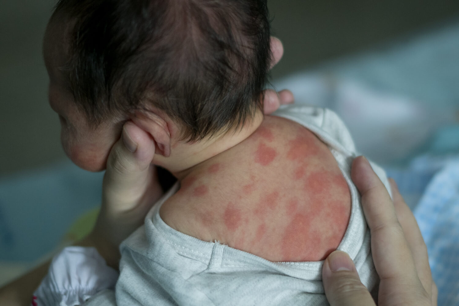 Thrush Baby Skin Rash