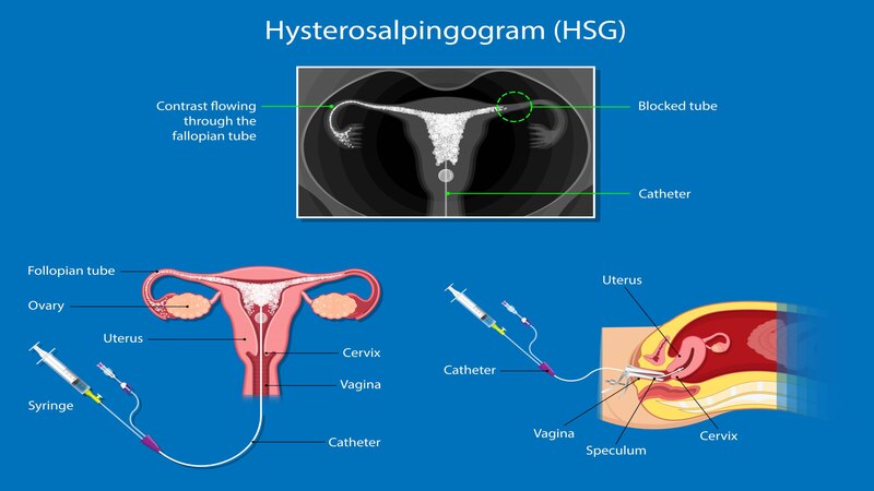 HSG-procedure-scaled