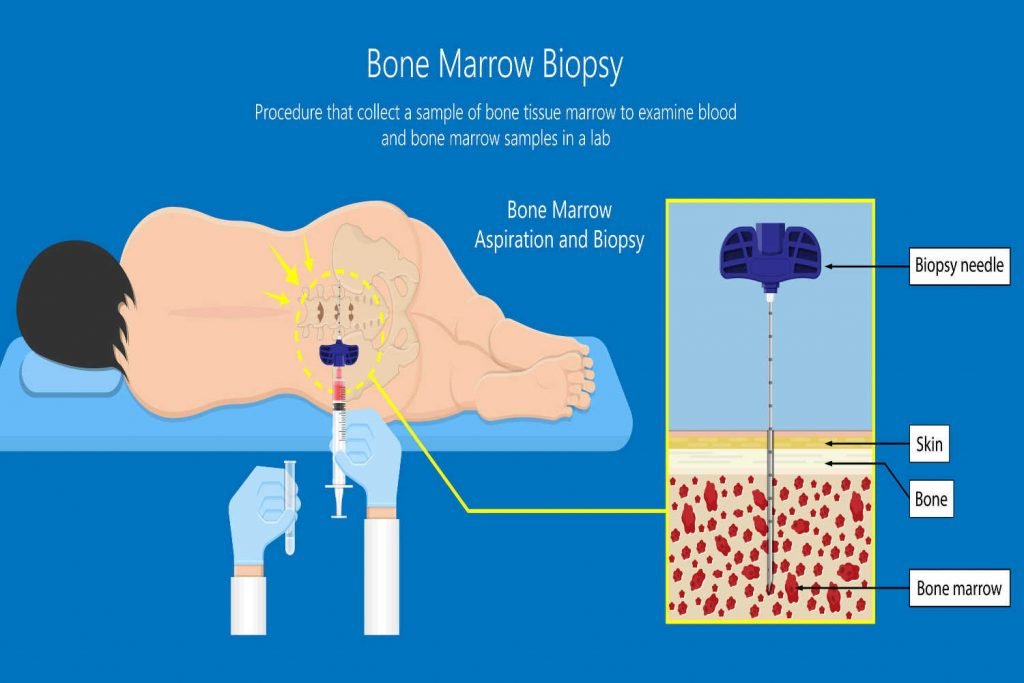 Neuroblastoma in Children: Stages, Symptoms, Causes, Treatment