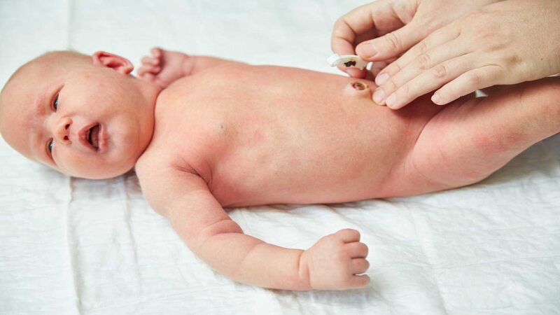 Omphalitis-in-Newborn