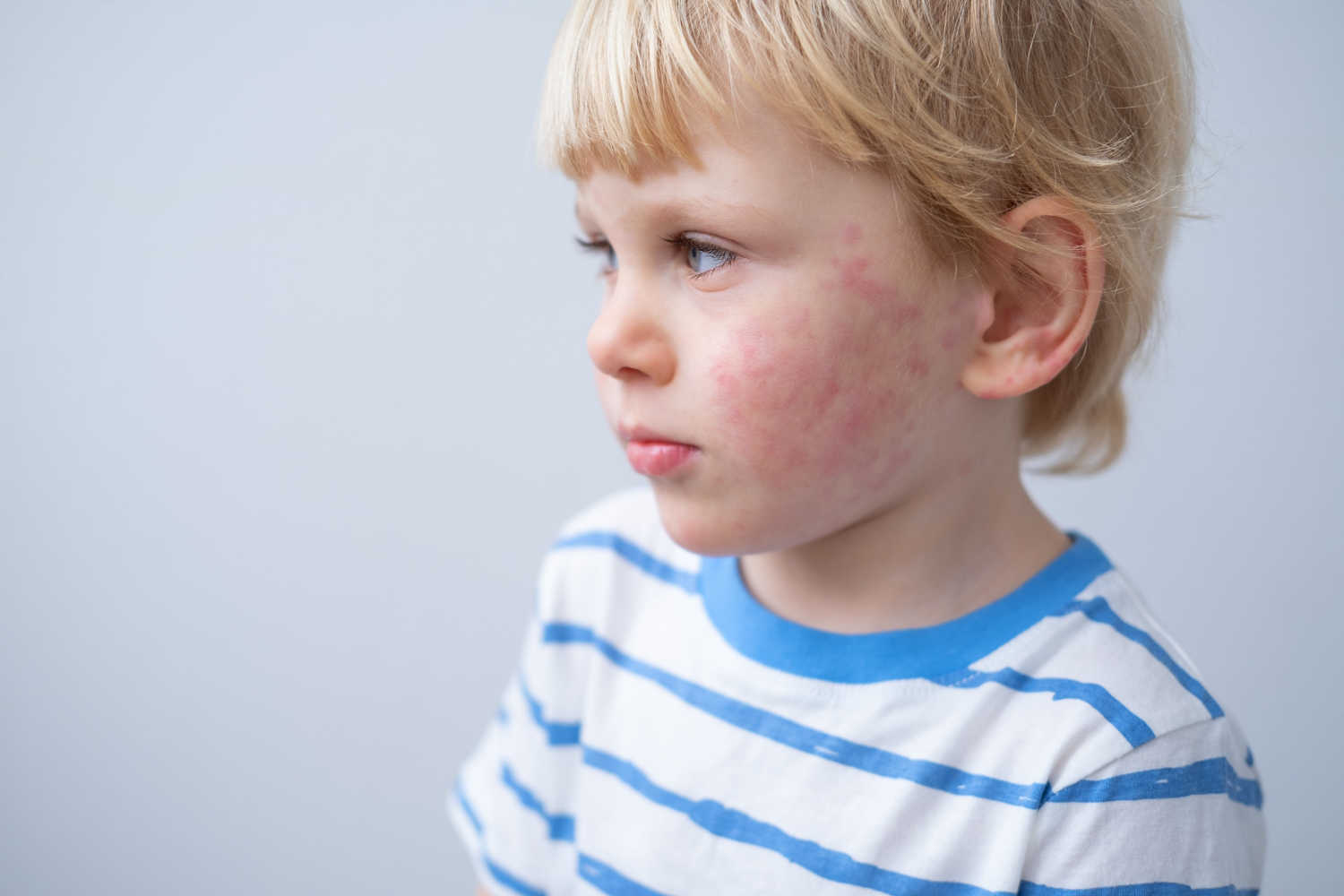 toddler-acne-how-common-and-top-tips-to-prevent-being-the-parent