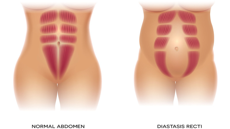 Abdominal-Separation