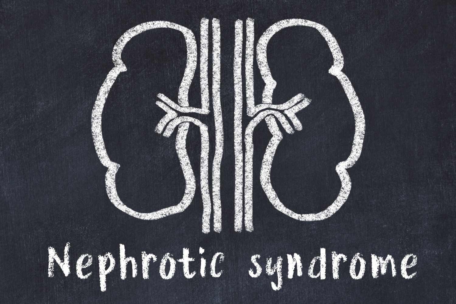 Nephrotic Syndrome in Kids - Being The Parent