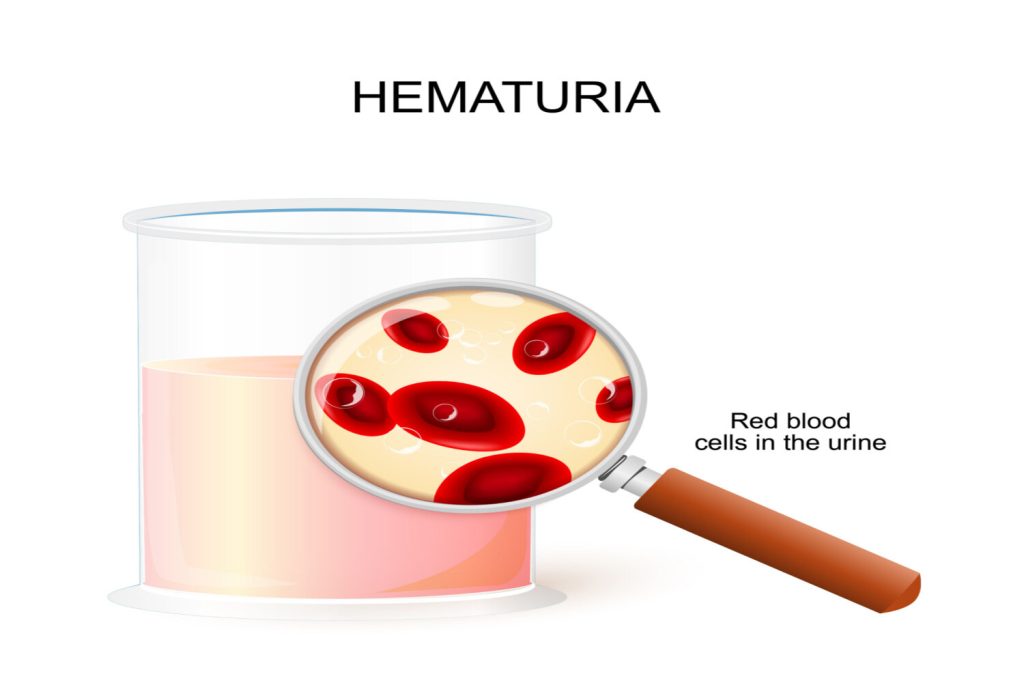 Hematuria (Blood in Urine) in Children - Causes, Symptoms and Treatment ...