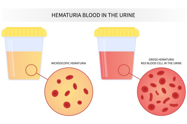 Hematuria (Blood in Urine) in Children - Causes, Symptoms and Treatment ...