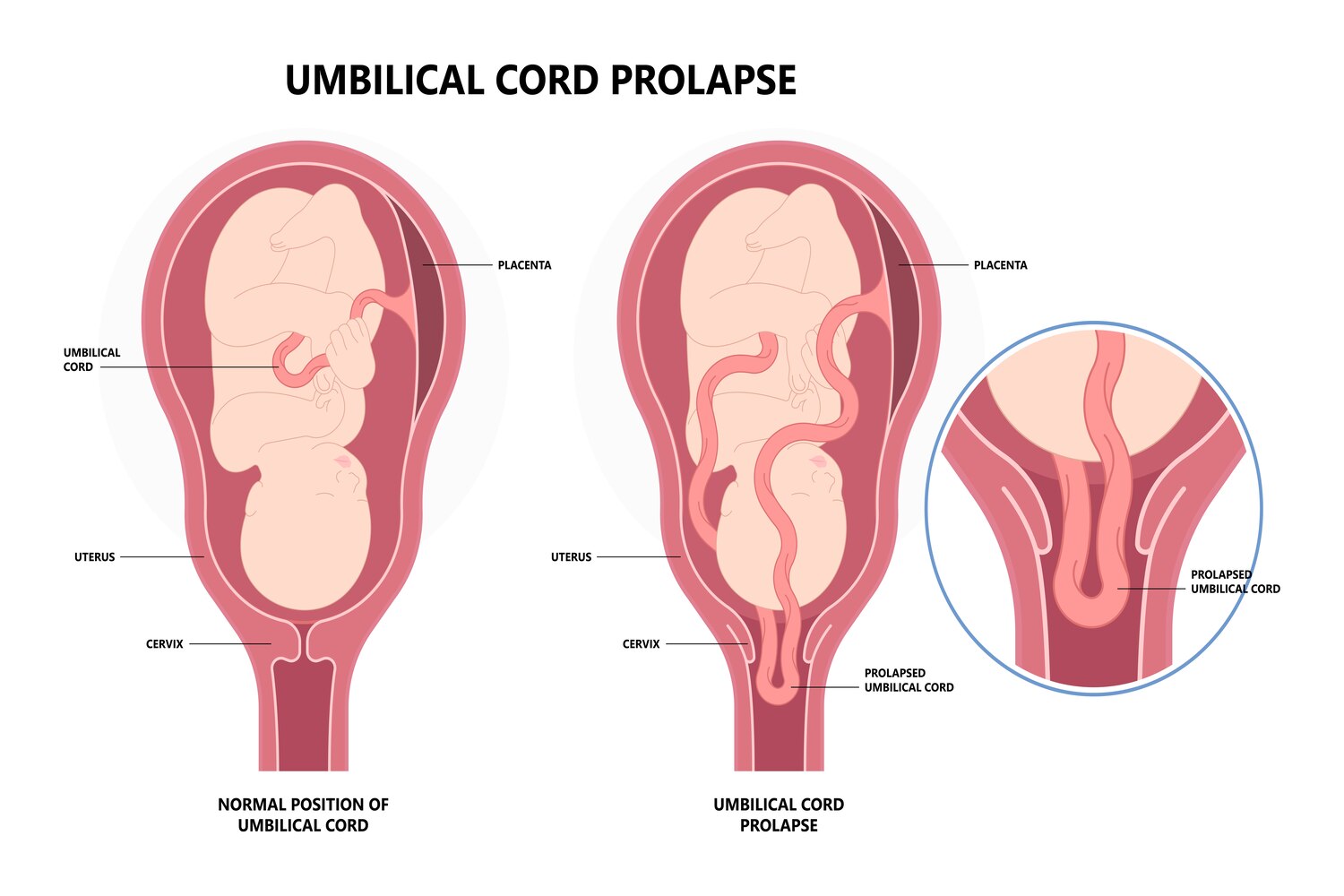 Complications Due To Polyhydramnios