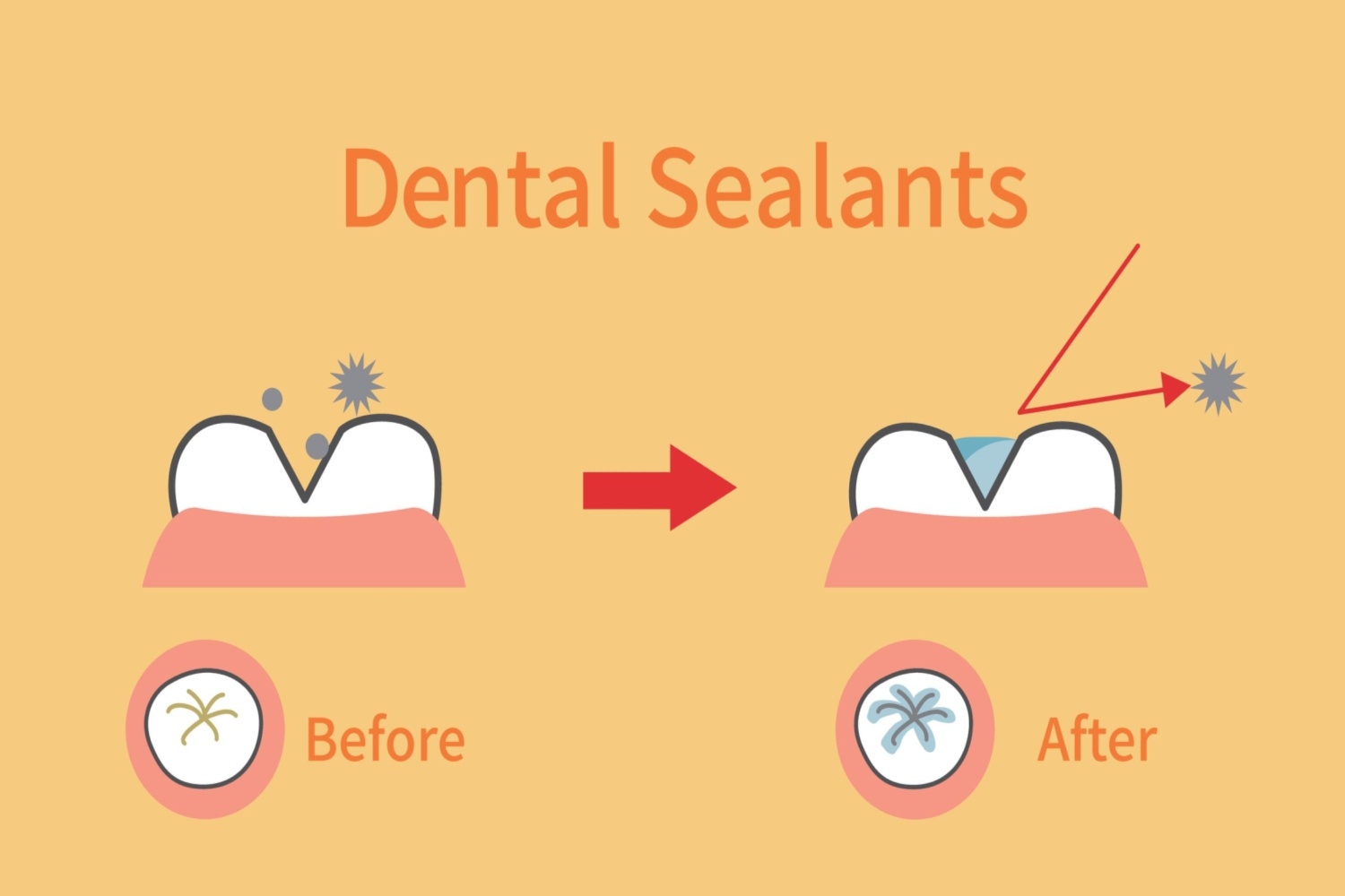 Dental sealants