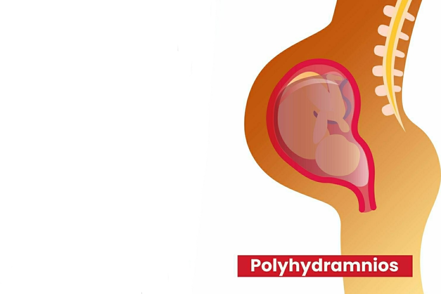 What Results In Polyhydramnios_