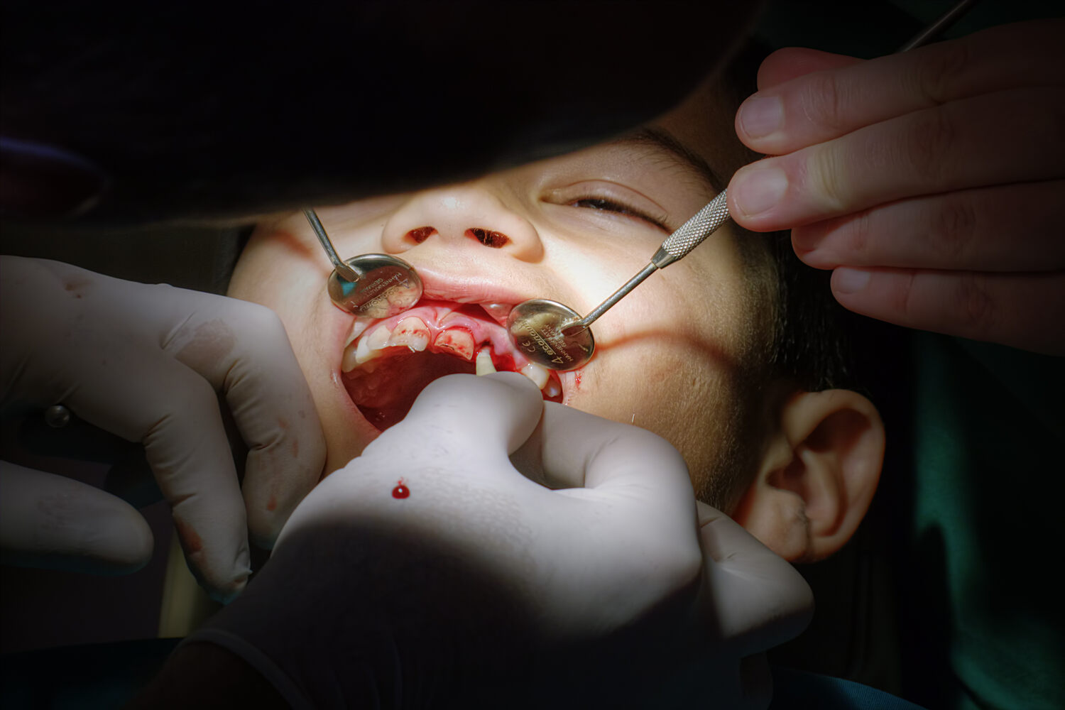 A toddler getting treatment for Avulsed Tooth