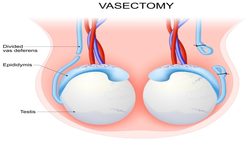 Pregnancy after Vasectomy – Chances and Reasons