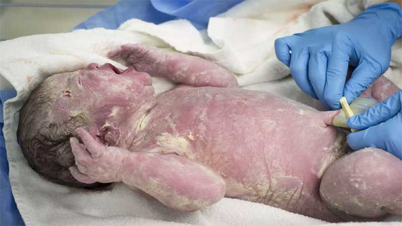 vernix caseosa role in babies