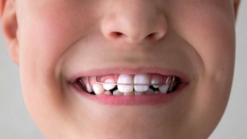 Different types of braces for the kids