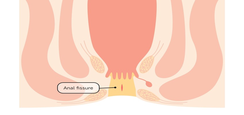 How Are Anal Fissures Diagnosed in Toddlers?