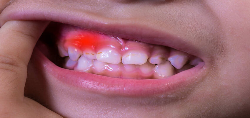 Gum Disease