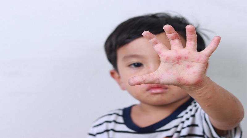 Hand-Foot And Mouth Disease In Children - 