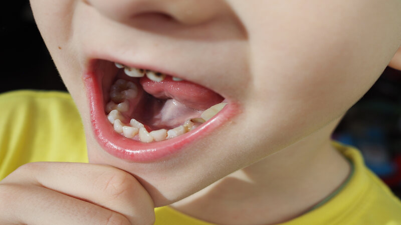 Hyperdontia in children