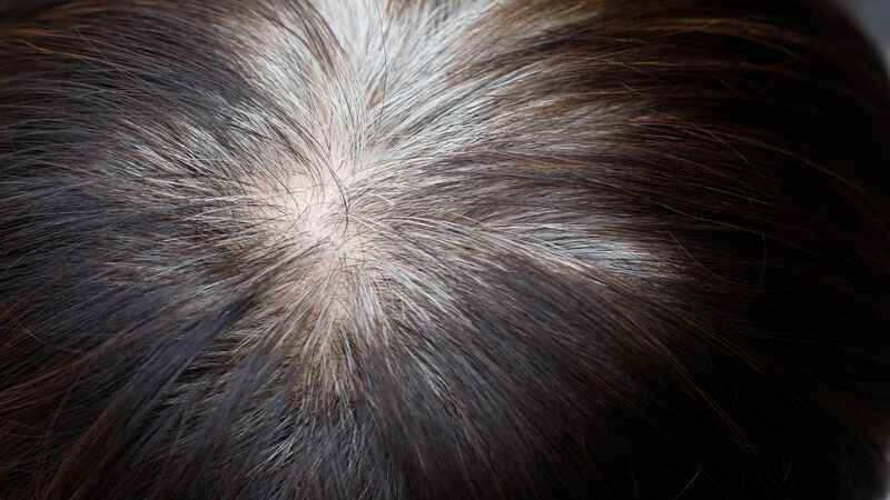 Premature gray hair in children